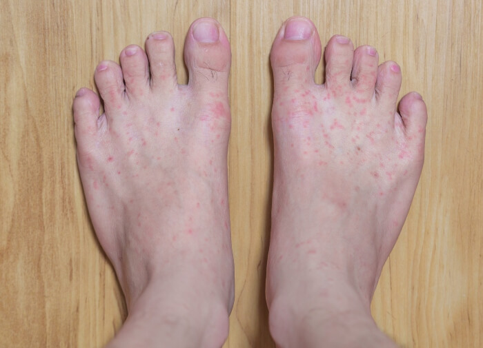 Foot Infection Signs - Redness, swelling & Itchiness